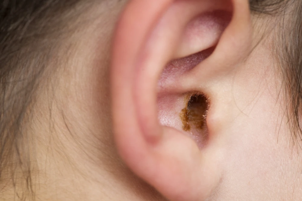 Ear Wax Removal Service